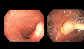 Pólipo hamartomatoso duodenal aislado genera anemia y hemorragia gastrointestinal en adulto mayor