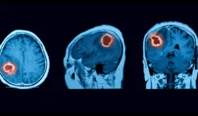 Cuidado con los golpes en la cabeza: Traumatismos craneales pueden desencadenar cáncer cerebral