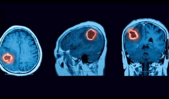 Cuidado con los golpes en la cabeza: Traumatismos craneales pueden desencadenar cáncer cerebral