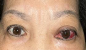 Seis meses de enrojecimiento ocular fue resultado de un adenocarcinoma
