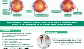Glaucoma - Infografía