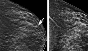 Uso de tintes, planchas o permanentes y el aumento en el riesgo de cáncer de mama