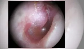 Miringotomía, intervención efectiva para drenar pus del oído debido a otitis o infecciones recurrentes