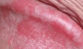 ¿Tiene el glande inflamado? Podría ser balanitis y estas son las 6 señales que debe tener en cuenta