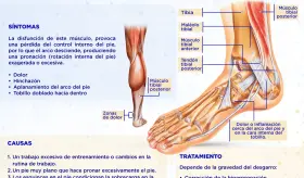 Tendinitis tibial posterior - Infografía