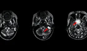 Mujer desarroll&oacute; met&aacute;stasis en la cabeza por tumor primario de mama diagnosticado hace 23 a&ntilde;os