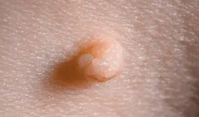 No todas las verrugas genitales son por VPH: verruga de agua y otros tipos que puede identificar