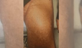 Masa en muslo interior y pérdida de peso significativa culmina en diagnóstico de liposarcoma