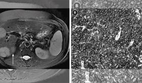 Linfoma extraganglionar de hígado, páncreas y bazo en paciente de 63 años con fibrosis hepática avanzada