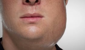 Parotiditis y la relación de las paperas con la infertilidad masculina o los anticuerpos espermáticos