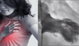 Síndrome del corazón roto o miocardiopatía por estrés y su íntima relación detonante con el cerebro