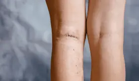 Flebectomía ambulatoria: todo lo que debe saber sobre el procedimiento para eliminar várices