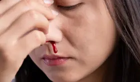 Epistaxis o sangrado nasal: ¿Cuáles son las causas y cómo puede tratarlo?