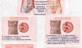Hernias de la pared abdominal - Infografía