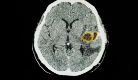Glioma pontino intrínseco: desarrollan una nueva terapia potencial para tratar este letal tumor cerebral