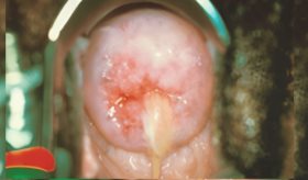 Micoplasma genital: Infección de Transmisión Sexual poco conocida que se asocia con cervicitis en mujeres