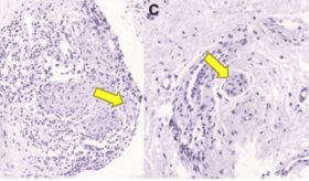 Estudio de caso revela alergias poco comunes en 3 pacientes con marcapasos