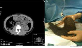 Bebé de dos años, con antecedentes de anemia, presenta rara bola de pelo en tracto gastrointestinal