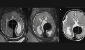 Equipo médico realiza con éxito la primera cirugía cerebral fetal en el útero materno