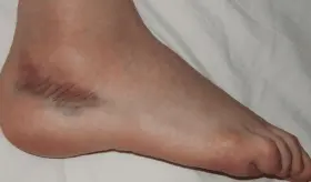 Los zapatos sueltos y el pie cavo aumentan el riesgo de esguinces y pueden dañar los tobillos