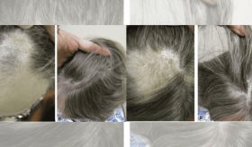 Tratamiento efectivo del liquen planopilaris con adalimumab en paciente de 61 años