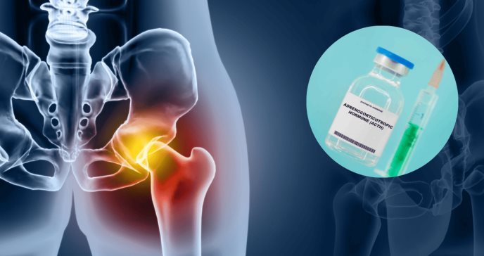 Corticotropina, así funciona el útil y poco conocido tratamiento para gota, artritis y otras condiciones