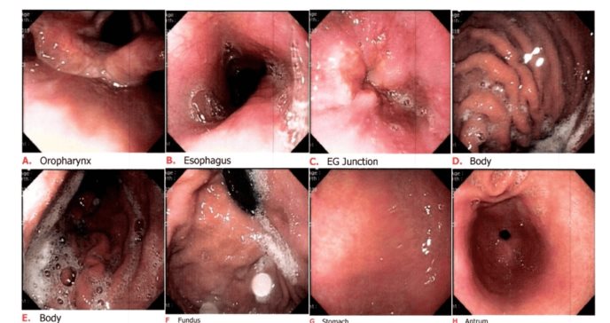 ¿Qué es la gastritis nerviosa y por qué es una respuesta del sistema digestivo al estrés y la ansiedad?