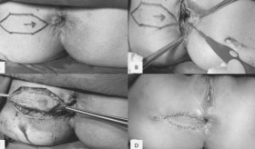 Reparación anal con colgajo de diamante en mujer de 57 años, tras dos años de cirugía hemorroidectomía