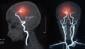 Sistema One Step Ictus permite reducir el tiempo de abordaje del ictus de 70 a 17 minutos
