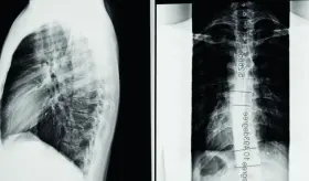 Así funciona la cirugía mínimamente invasiva que corrige la escoliosis