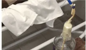 Utilizan aguardiente en un caso de drenaje torácico como medida de emergencia