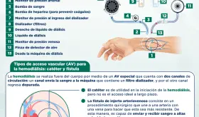 Insuficiencia renal y hemodiálisis | Infografía