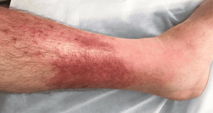 Relación entre linfedema, insuficiencia venosa y enfermedad vascular con recurrencia de la celulitis