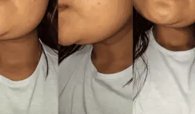 Inflamación de ganglios linfáticos: ¿Puede ser signo de cáncer?