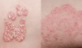 &iquest;Eczema o micosis? La diferencia entre ambas condiciones que afectan la piel