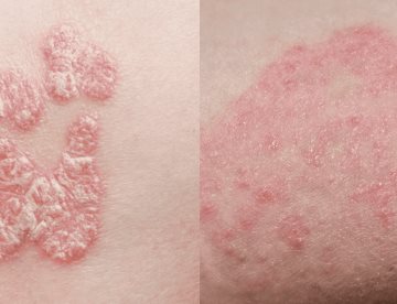 ¿Eczema o micosis? La diferencia entre ambas condiciones que afectan la piel