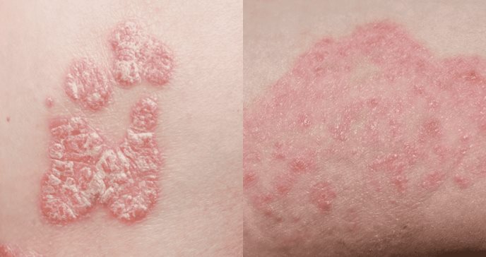 ¿Eczema o micosis? La diferencia entre ambas condiciones que afectan la piel