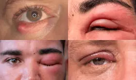 La celulitis que afecta el ojo: ¿Qué es y por qué se origina?