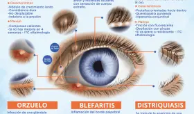 Trastornos de los párpados | Infografía