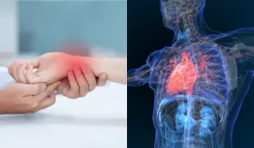 ¿El síndrome del túnel carpiano puede predisponer a la insuficiencia cardíaca?