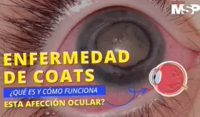 Enfermedad de Coats: ¿Qué es y cómo funciona esta afección ocular?