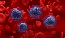 Cinco puntos claves para comprender la Leucemia Mieloide Aguda