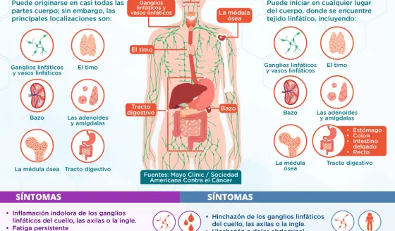 Linfoma de Hodgkin VS Linfoma de no Hodgkin | Infografía