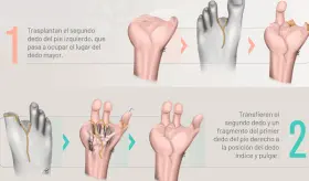 Especialistas reconstruyen mano de joven tras accidente utilizando los dedos de sus pies