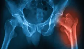 Osteoporosis en hombres: una amenaza subestimada que causa 80,000 fracturas de cadera al año