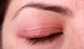 Los 7 distintos tipos de infecciones oculares que pueden causar pérdida permanente de la visión