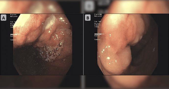 Extraño caso de metástasis en estómago y colon por inusual complicación de cáncer de mama