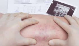 Riesgo de trombosis venosa profunda posterior a una cirugía: prevención, cuidados y tratamientos