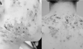 Paciente con &uacute;lceras es diagnosticado con acn&eacute; fulminans tras infecci&oacute;n de coronavirus y pulmon&iacute;a