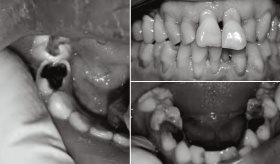 Importancia de la alfabetización bucodental y la prevención de afecciones bucales, según estudio
